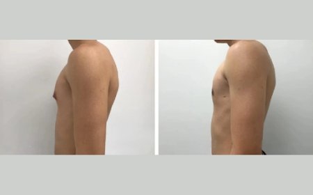 Is Gynecomastia Surgery the Best Option for You in Dubai?