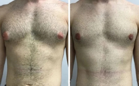 When Should You Consider Gynecomastia Surgery in Dubai?