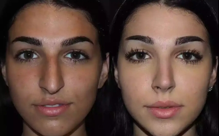 Nose Surgery in Dubai for Breathing and Beauty