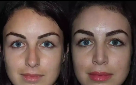 Nose Deviated Septum Surgery in Dubai for Athletes