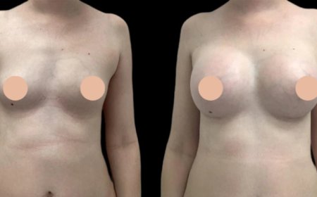 Looking for the Best Breast Augmentation Surgeon in Dubai?