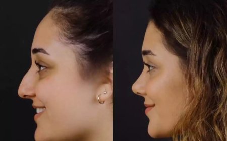 Trusted by Thousands: Best Septoplasty Surgeons in Dubai You Should Know