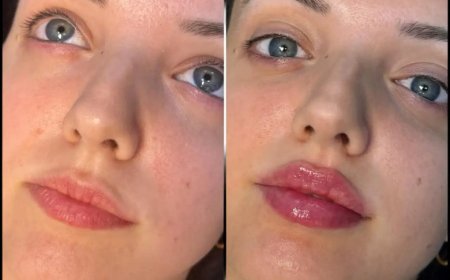 Achieving Perfection with the Best Doctors in dubai for Fillers