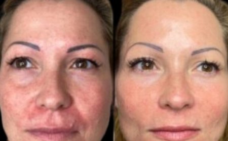 Activate Skin Vitality at the Best Aesthetic Clinics in dubai through Profhilo