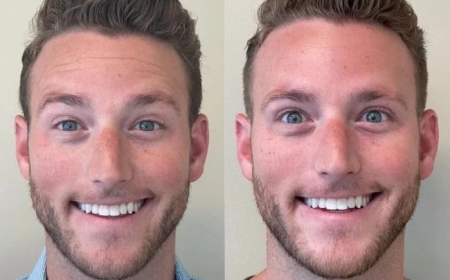 Botox in Dubai for Men: Breaking Down the Myths and Increasing Popularity