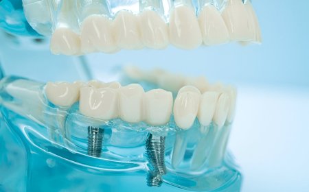 Restore Your Smile with Dental Implants in Coral Springs at MSD Dental Studio