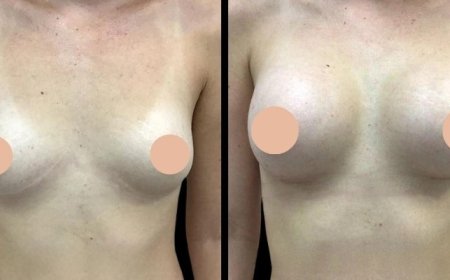 Breast Augmentation Surgery in Dubai: Silicone vs. Saline Implants