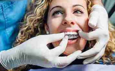 From First Fit to Final Smile: The Invisalign Journey