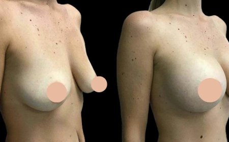 Best Breast Augmentation Surgeon in Dubai for Breast Asymmetry Correction