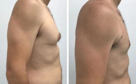Recovery After Gynecomastia in Dubai: What You Need to Know