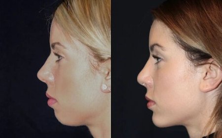 Best Aesthetic Clinic in dubai for Chin Fillers: The Art of Facial Sculpting