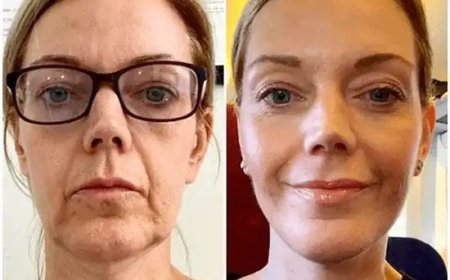 Channel Skin Elegance at the Best Aesthetic Clinic in dubai with Profhilo