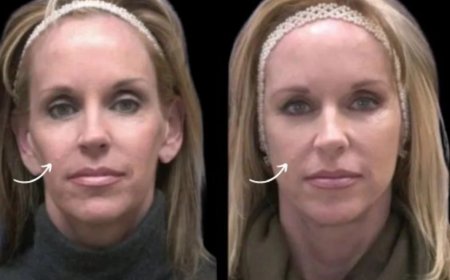 Tailored Sculptra Fillers Roadmaps: Best Plastic Surgeons in Dubai